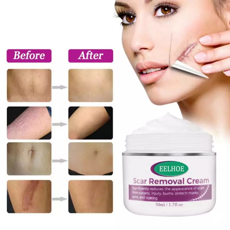 Scar Repair Cream Acne Scar Treatment Serum Removal Stretch Marks  Discoloration Surgery Burn Smooth Skin Care